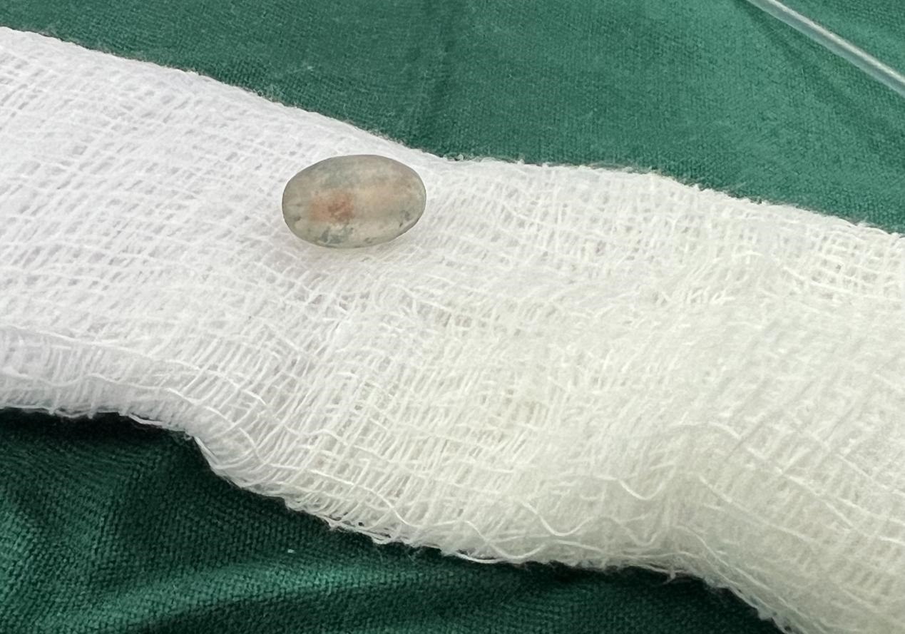 被取出的異物。中國援桑醫(yī)療隊(duì)供圖