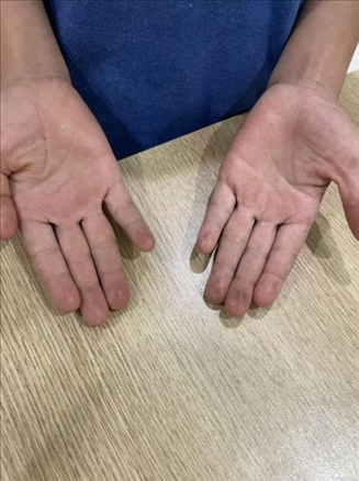 9歲小學(xué)生長(zhǎng)期拍煙卡，手部粗糙長(zhǎng)繭。受訪者供圖